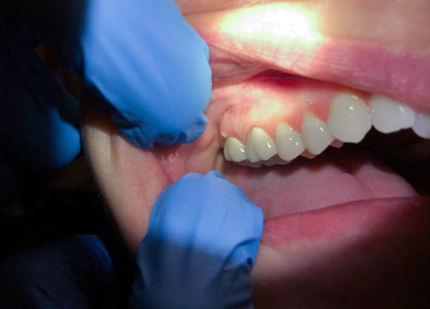 Best Emergency Dentist for Knocked-Out Tooth in Union City, GA